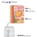 위암 수술 후 부작용과 관리에 관하여 이미지