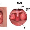 목안 염증 통증이 반복된다면? 원인 제거 이렇게 이미지