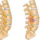 좌골신경통 좌골 신경통 원인 허리 디스크로 오인하는 좌골신경통 이미지