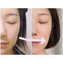 폴라동물병원 | 명동역피부과 텐써마 300샷 2주차 비포 애프터 후기