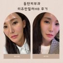 동탄피부과 리쥬란힐러HB 2cc후기