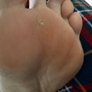 멜로우피부과의원 | 신사역 피부과전문의 찾는다면? 와이프 발바닥 티눈 VS 사마귀 무엇이었을까?