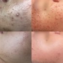 퓨리티바이오 | [뽀슌에스테틱] 3월 프로모션 미니페이스 데콜테 & 피부 패키지 특별 혜택 안내