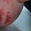 더나은파트너스 | 아기 엉덩이 발진 심할때 진물 상처 여러가지 시행착오 후 3일만에 나은 관리방법