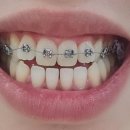 비에스치과의원 | 대구 치아교정 저렴한곳 "비에스 치과의원" 부정교합/돌출 치아 교정 후기