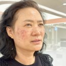 루비약국 | 홍대피부과 잡티 기미제거 1회만에 효과 본 루비레이저 후기
