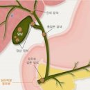 담석증 및 통증 원인 검사 제거 : 쓸개 담석 담낭결석 이미지