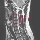목 디스크치료사례-6 김*구님 남자/40세 경추 4-5번간 추간판 탈출증 (신경압박으로 인한 팔 근력 저하및 마비 동영상) 이미지