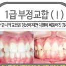 1 2 3급 부정교합 원인과 교정 (반대, 과개, 개방 교합) 이미지