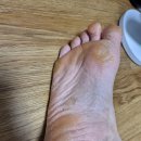 영아상회 | 제품 사용 후기, 무좀 치료제 티어실 원스 외용액