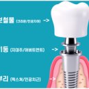그리치과기공소 | 가평치과, 의사들은 임플란트 브랜드 안 봅니다 [의사 작성]