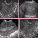 자궁내막증식증과 자궁내막암의 연관관계 이미지