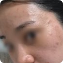 (주)네오제네시스 | 과천 여드름 피부관리, 레이저 후기 [네오빔,엑셀혈관,스케일링]