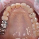 스타교정치과기공소 | 대구 치과기공소 / 앞니 전치부 보철, 전후 차이가 이렇게 달라집니다.🦷