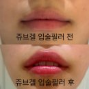 모야짐 | 압구정피부과 추천 쥬브겔 입술필러 후기!! 내돈내산 전후 비교