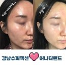 강남피부관리 슈퍼젝션 어나더핸드 예민피부 일주일 변화과정 솔직후기