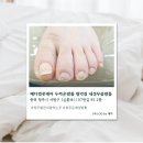 서원메디칼 | [청주] 청주발관리 메디컬풋케어 두꺼운발톱 발각질 내성무좀발톱 솔직후기