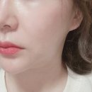 압구정 피에이치디 피부과 울쎄라피프라임 후기 울쎄라2 울쎄라피프라임 내돈내산 효과