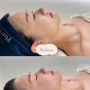 디엘르테라피