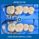 금호정든치과의원 | 성동구치과, 자연치아를 살리는 레진빌드업 치료란