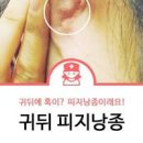 귀뒤 염증 귀바퀴 염증 물나옴 귀에서 진물 이미지