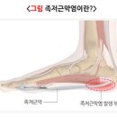 족저근막염 원인 증상 족저근막염 치료방법 이미지