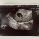 마곡휴연합의원 | [시험관 1차 성공 후기] 감자와 눈사람 신선이식 5일배양 졸업