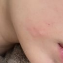 홍대디온의원 | [홍대 피부과] 디온의원 입꼬리보톡스 내돈내산 후기 (2만원 가성비 시술/ 효과 /부작용)