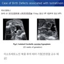 여드름약 이소트레티노인 복용 3명 중 1명꼴 인공유산 경험 이미지