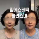마곡 피부관리 림에스테틱 플라즈마 라이너 오르네시술 주름관리 심부볼 후기