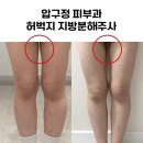 (주)압구정하루 | 압구정다이어트병원 허벅지지방분해주사 내돈내산 추천후기
