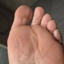 휴피부과의원 | 청담 휴피부과 양발 티눈 제거 후기 (강력 추천!!!)