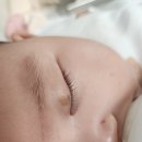 밀크피부과의원 | [육아일기] 마포 공덕 에스앤유 피부과 아기 얼굴 눈꺼풀 밀크커피반점 진료 후기(예약/주차)