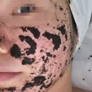 마곡나루 여드름 관리 '림 에스테틱' 1:1 여드름 관리 솔직 후기 (피지·화농성 피부 개선)
