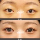 아이델성형외과의원 | 부분절개 첫눈성형, 매몰과 절개의 차이 정확히 알고 선택하세요.