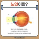 노안 이미지