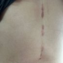 pet25무0799 | #31. 서울대 담도암 수술 3년 무사히 통과했습니다! (비타민 복용, 수술 흉터 사진, 식단 공유)