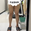 무제한 지팻주사 허벅지 지방추출 재방문 리얼 후기!! -2탄-