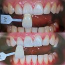 선치과의원 | 대전치과 치아미백 누렁니 탈출 솔직후기