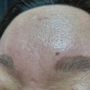 밸류메디컬 | 파메스테틱 세멘잘라이트 1년사용 후 탄력되찾은 솔직후기(내돈내산, 사용방법)