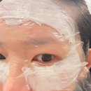 신논현역 성형외과 눈가에 스킨부스터 리투오 파인 후기