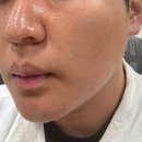 분당피부과 BBL레이저 포에버영 남자 홍조 잡티 제거 후기