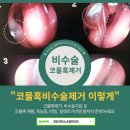 청담경희소순필한의원 | [공지] 비염,코막힘,축농증,코물혹 비수술 치료 [ 청담경희소순필한의원]
