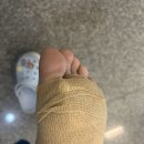 사마귀 레이저 치료