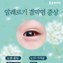알레르기 이미지