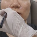 모찌이야기강남 | 강남역 피부과전문의 첫 방문 후기! 팔자주름 힐로웨이브 2cc 내돈내산 후기 (전후사진 포함)