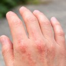 한방고등학교 | 한포진치료, 한포진연고 찾다가 결국 선택한 방법 – 3개월 관리 솔직 후기