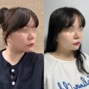 포마티 | 압구정역피부과 인모드FX 포마 얼굴전체 후기 이중턱 심부볼 붓기 변화