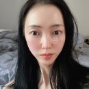 [팔자주름 후기] 20대도 예외 없던 깊은 주름, 지우개로 싹 지운 후기 쥬베룩 볼륨 (내 돈 내산)