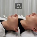 오글로시 | ［ 성동 / 성수 ] 서울숲 피부관리 오글로시 대표원장 맞춤 파워웨이브 관리 후기
